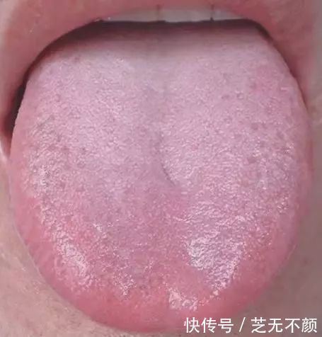 舌头中间有裂纹 或者边缘有齿痕等 是 大病征兆 快资讯 舌头中间有裂纹 或者边缘有齿痕等 是 大病征兆 快资讯