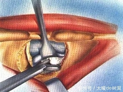 腰椎间盘突出症：保守治疗方式有哪些？什么情况会选择手术治疗？