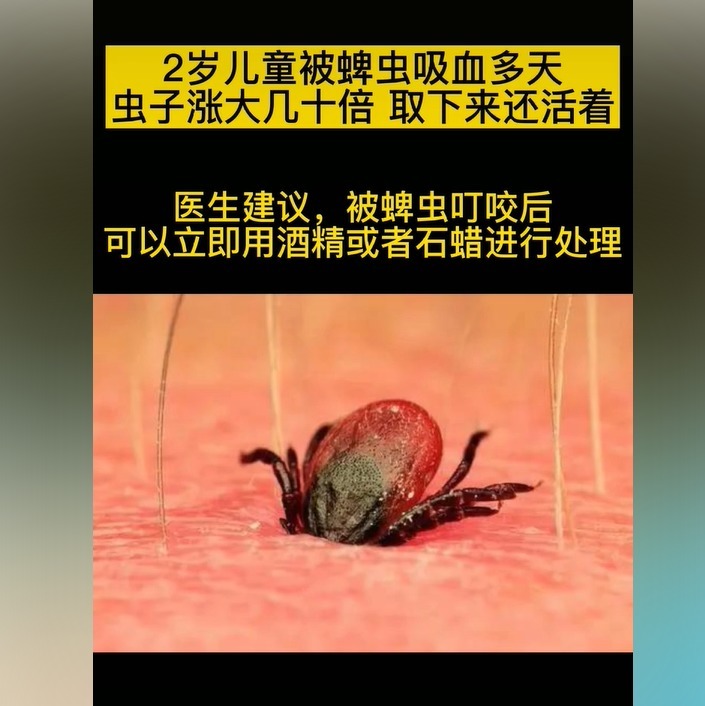 医生|3岁孩子被蜱虫咬,妈妈的“三个果断”救了娃,医生点赞有见识
