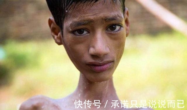 利瓦|男孩头部怪异,只能挂在胸前,手术7个月后的模样让人感动到哭!