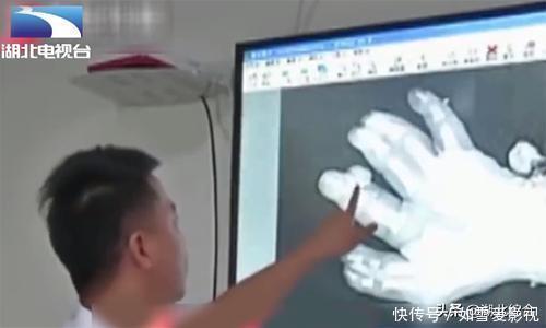 新生儿|罕见!新生儿有25根指头,一看到妈妈的手,医生瞬间明白了