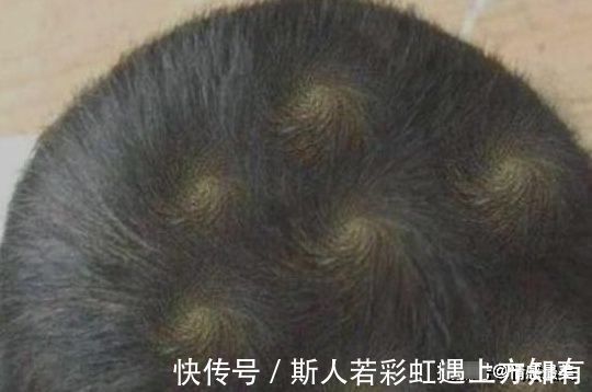 宝宝|宝贝头上的“头旋”个数代表啥?可能很多宝妈还不清楚