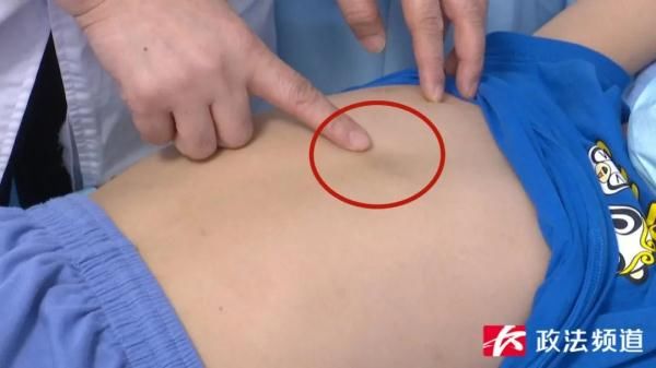 湖南|经常这样喝水，湖南10岁男童感染寄生虫裂头蚴