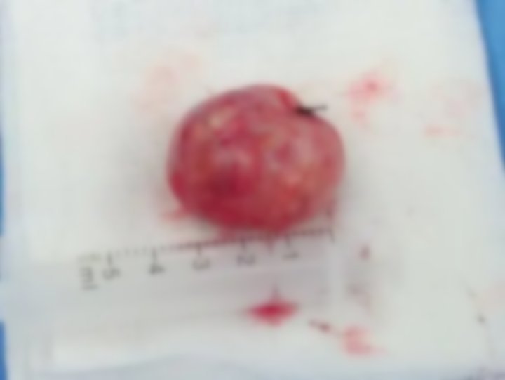 神经纤维瘤|医院先后来了两个男子，毛病几乎一样脖子上长了“鹌鹑蛋”，按按手还有触电的感觉……