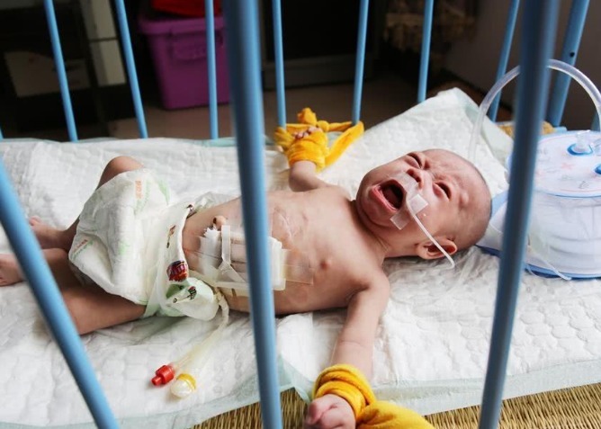 管子|妈妈生下双胞胎女儿,看到大女儿时妈妈发呆,只能用绳子绑住