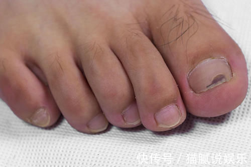 脚部|血糖超标时,双脚先知道?脚上出现异常现象,警惕糖尿病足到来