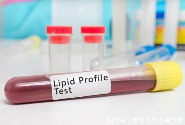 血脂|52岁王先生半年甘油三酯从5.1降到1.7,医生:或因坚持做了3件事