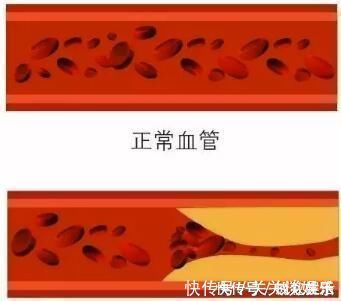 甘油三酯|三位院士声明开水里加一勺,连喝15天,血管通透明亮,血脂悄悄