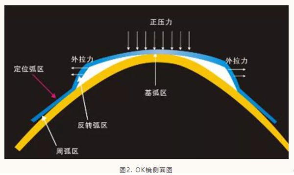 角膜|孩子有散光，可以配OK镜吗？