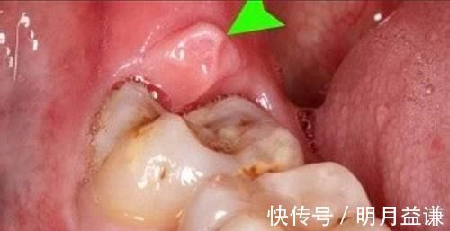 口腔疾病|哪些疾病需要在备孕的时候处理,否则怀孕后可能会后悔莫及?