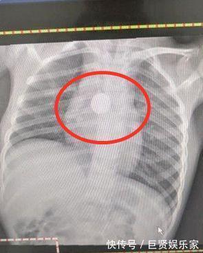 项链|5岁女儿暴瘦,医生检查后让娃“摘下项链”,妈妈懵了她没戴啊