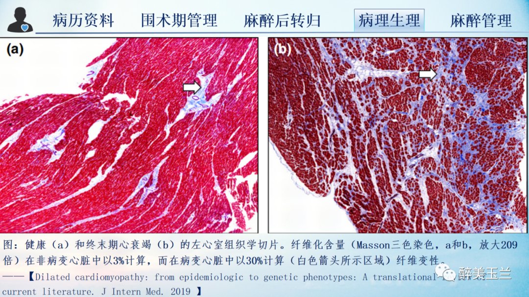 扩张型心肌病患者非心脏手术的全身麻醉一例|病例讨论 | 全身麻醉