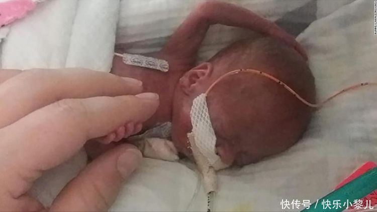 斯科特|提前5个月出生的早产儿一岁啦!吉尼斯认定为:世界最早产婴儿