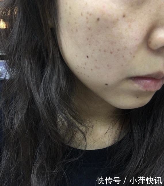 耳垂|血脂偏高的人，头部或有4个表现，若想调节血脂，给你2个小建议