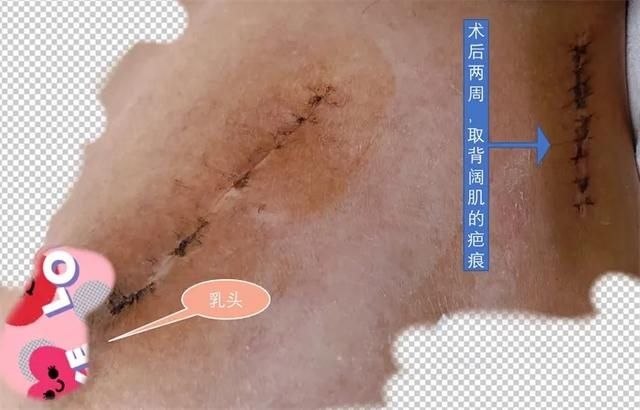 彤彤|20岁女大学生患乳腺癌左乳被切除，背阔肌华丽“转身”变漂亮乳房