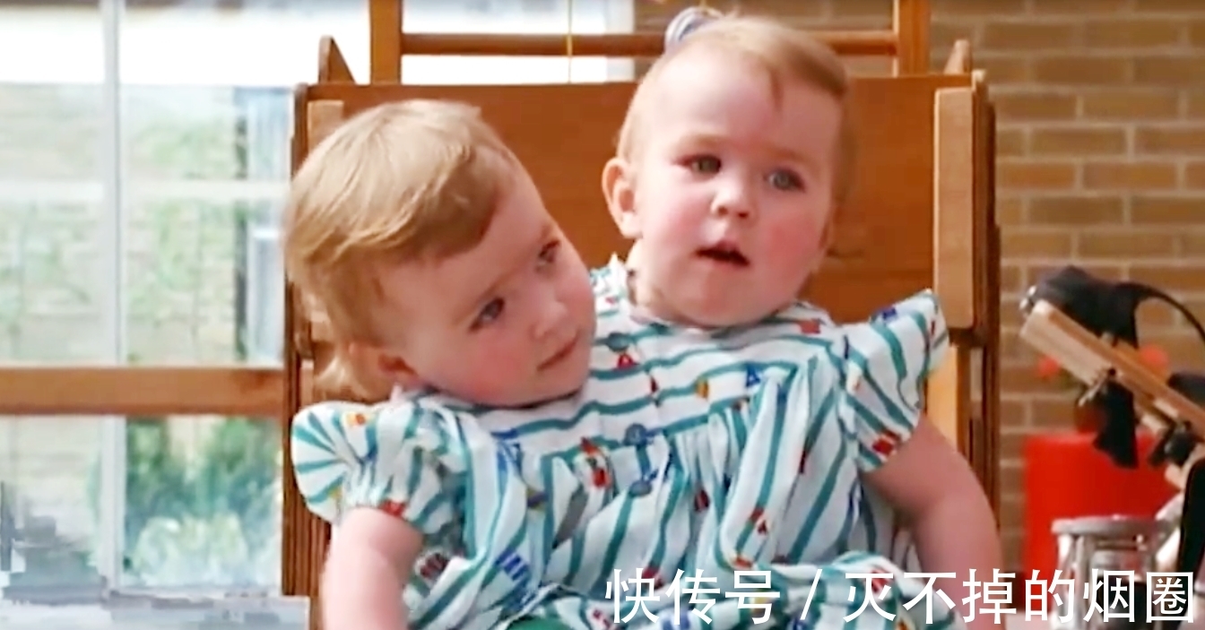 索菲亚|2女孩共用一个躯体生活3年,要将她们个体分离,能成功吗?