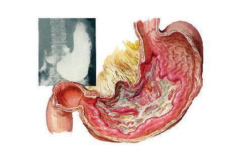 心肌梗塞|不论你酒瘾有多大，若得了这6种病，建议远离酒精，早知道早好