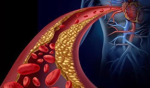 常吃|脑供血不足，跟4个原因脱不了关系，常吃一物，血管通，供血足
