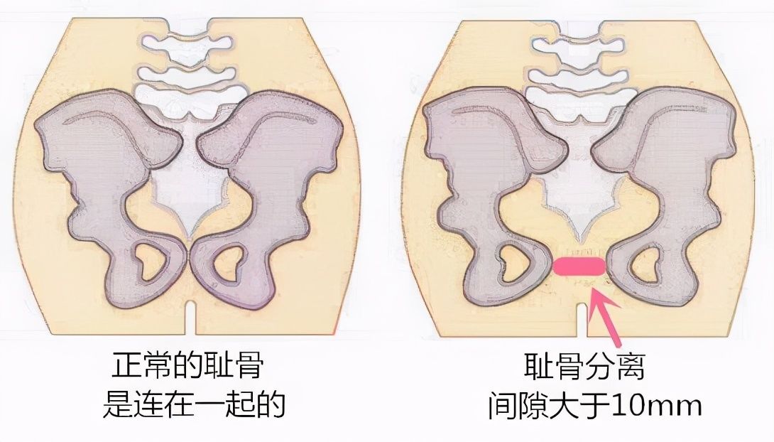 误区|美妈咪产后恢复——别再有这样的误区了，剖腹产也要做骨盆修复