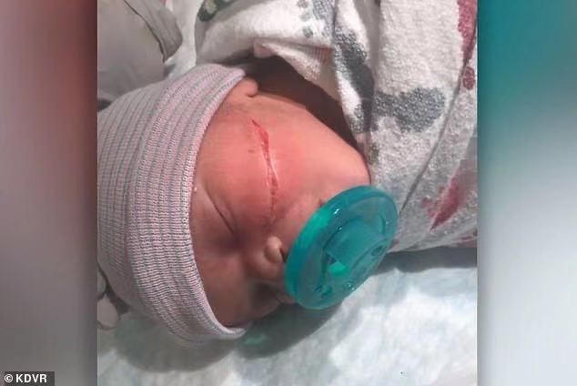 毁容|揪心！剖腹产手术致女婴毁容 严重划伤已缝合13针，未来还需整形