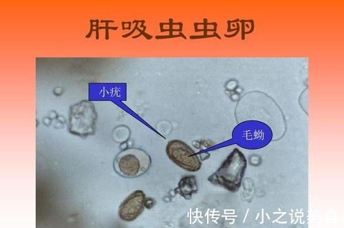 驴友|34岁驴友持续腹泻21天后,查出艾滋和肺吸虫,她的教训令人深刻