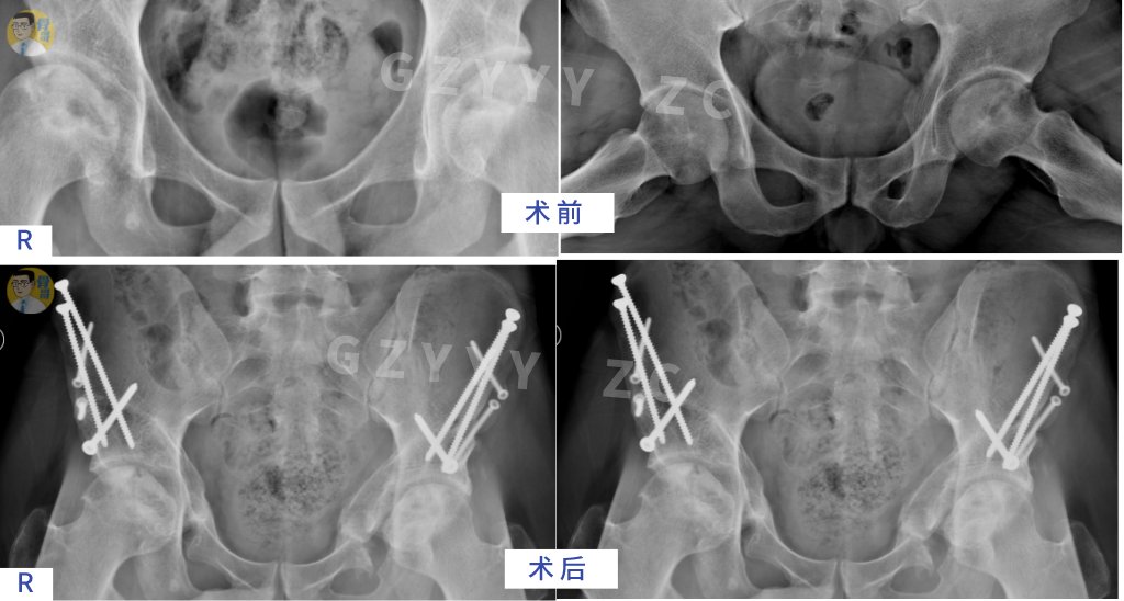 手术|看准、选对、做好——股骨头坏死保髋就这样成功了？