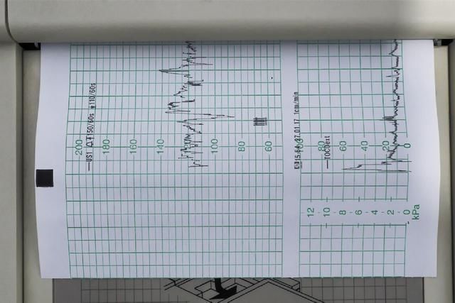 胎心|进行胎心监护,一会儿合格,一会儿不合格,是胎儿“缺氧”吗?