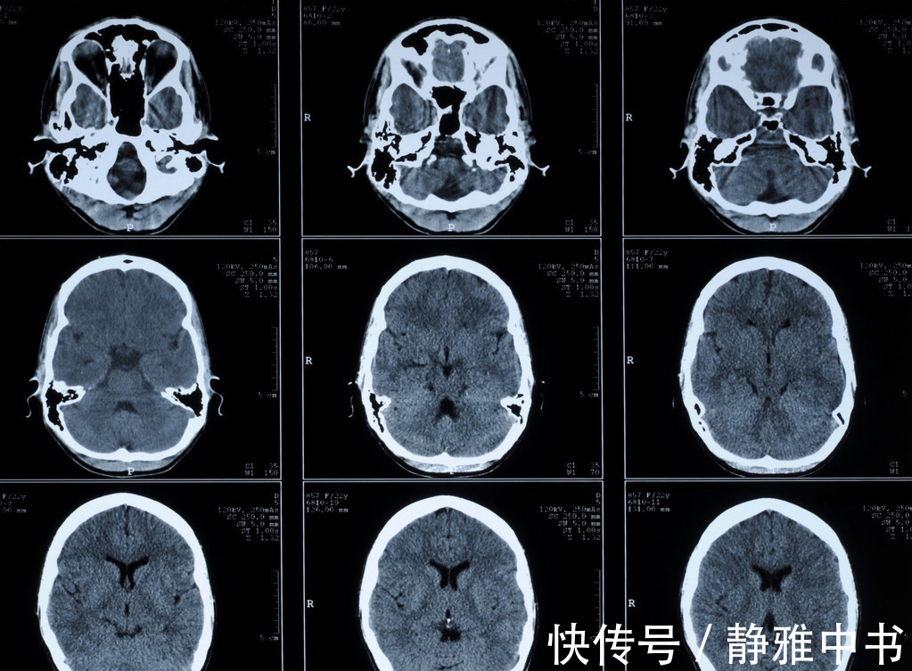 超声检查|很多人不重视脑供血不足,却不知道是脑中风的前奏,如何检查预防