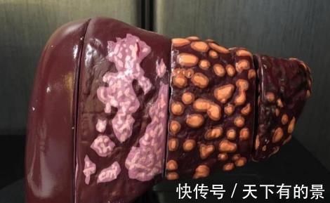 肝脏|肝脏若不健康,可能会收到此些信号,别假装没看到忽视了