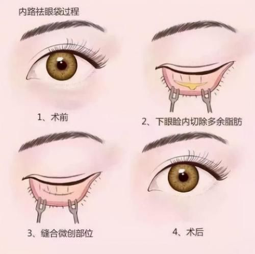 眼袋和黑眼圈是我们的颜值“天敌”！该如何应对？这3招或可参考