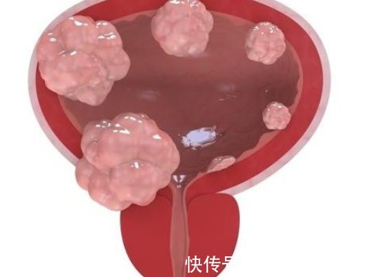 起夜|晚上起夜与不起夜,哪个更健康?泌尿科医生现在为你解答!