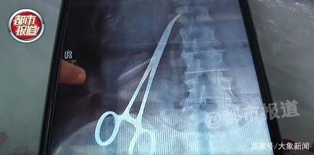 祝燕|女子剖宫产后疼了一年，才知是止血钳遗留腹中！