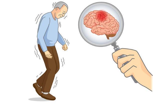 脑梗来临前不痛不痒?发现这些异常别迟疑,越早检查越好!