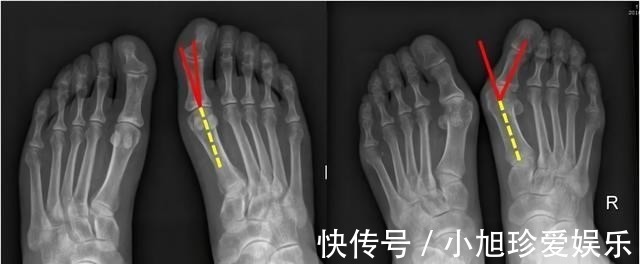 拇囊炎|穿高跟鞋的危害到底有多大？