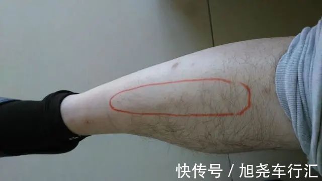 运动|血脂高不高，看小腿就懂？若有这4种症状，或在暗示血脂偏高了