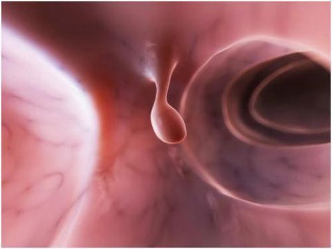 增生|结节、息肉、囊肿、增生...哪个才是癌症的先兆