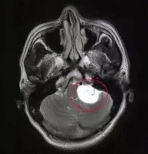 12岁男孩一笑就停不下来?医生发现:头里肿瘤有7毫米