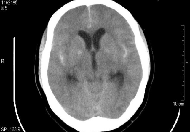 中风|高血压的危害