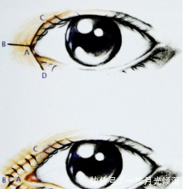 内眦赘皮 开眼角手术怎么做才能不留疤隆鼻能改善眼角吗!