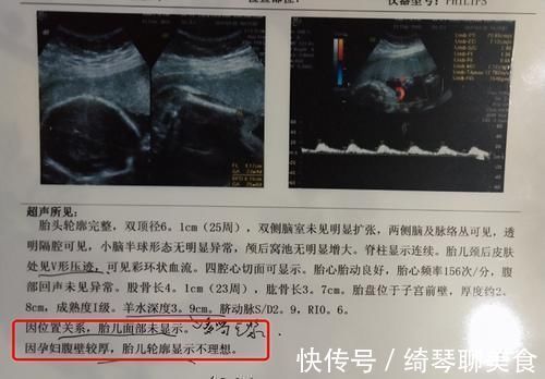 彩超|被宝宝的四维彩超照丑哭了?不是医生技术不好,而是有客观原因的
