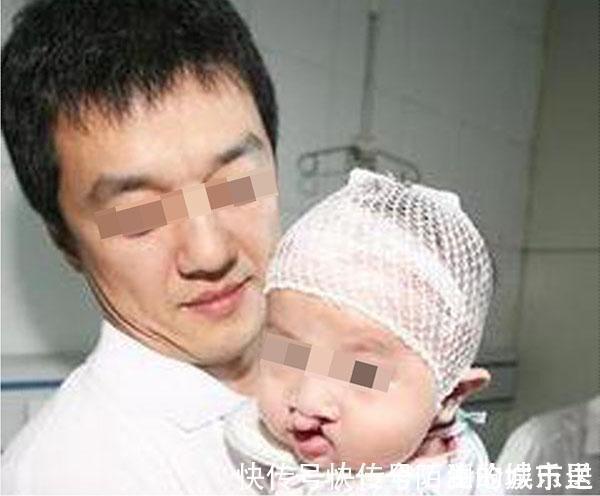 兔唇|医生三类孕妇容易生“兔唇”宝宝,如果你在其中,就要小心了