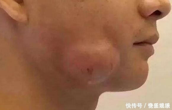 痘痘|小伙脸上慢慢鼓起大包，去医院检查，拍完的片子让医生很意外