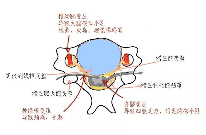 颈椎病 后半生瘫痪 你需要知道这四种类型的颈椎病 全网搜