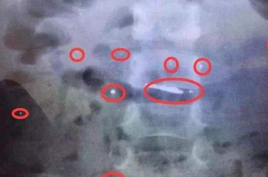 二宝|3岁女儿误吞水银,奶奶坚持吃完韭菜再去医院,医生点赞做法高明