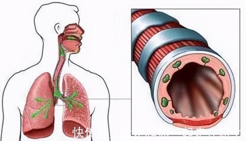 呼吸道感染|支气管扩张很可怕？医生：做好这几点，要你长寿