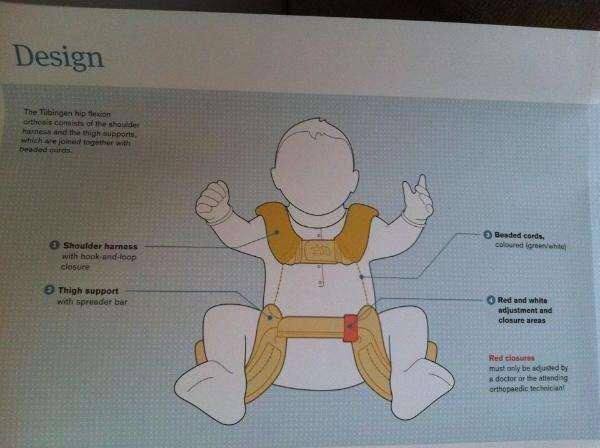 发育不良|宝宝髋关节发育不良戴吊带矫正会影响腿型吗