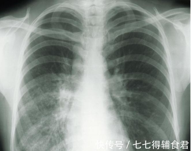 痰湿|肺不好的、肺上有结节,每天2个动作20分钟,让肺越来越健康