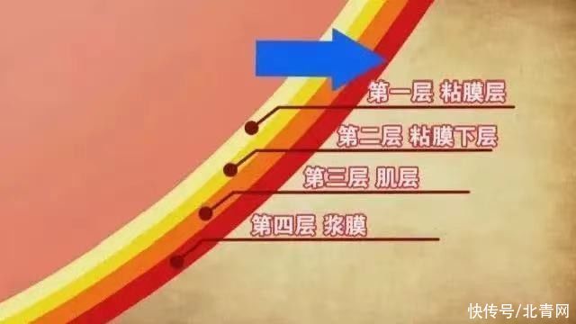 胃食管反流|胃病无小事，一不小心可能拖成癌！有这些迹象要及时就诊