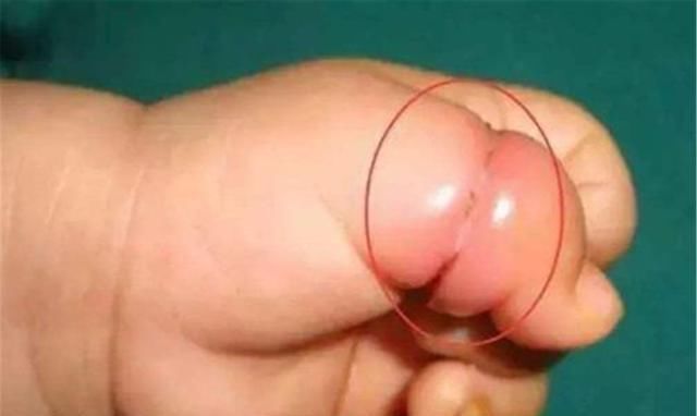 宝宝|为防宝宝抓伤脸、吮手指,给宝宝戴上手套可不值得,危害很大