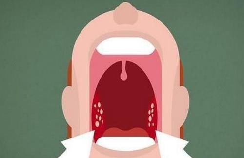 扁桃体结石是如何形成的 扁桃体结石有哪些症状 快资讯